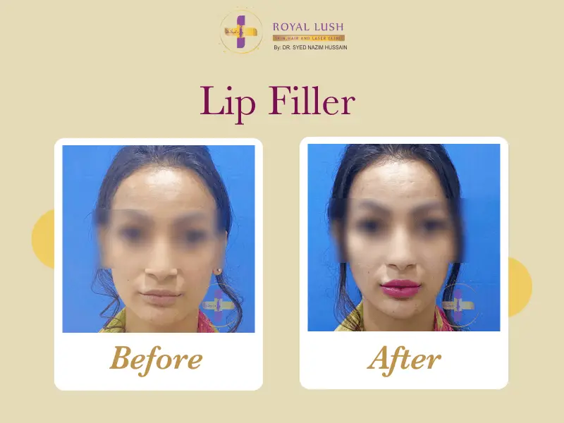 Lip Filler Treated by Dr Syed in Royal Lush Clinic IN South Delhi Before after